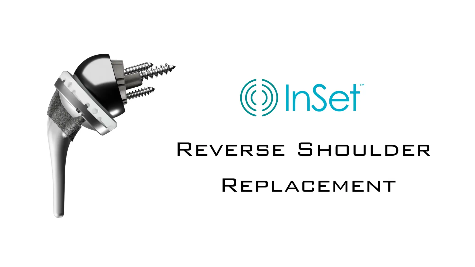 InSet™ reverse shoulder replacement implant