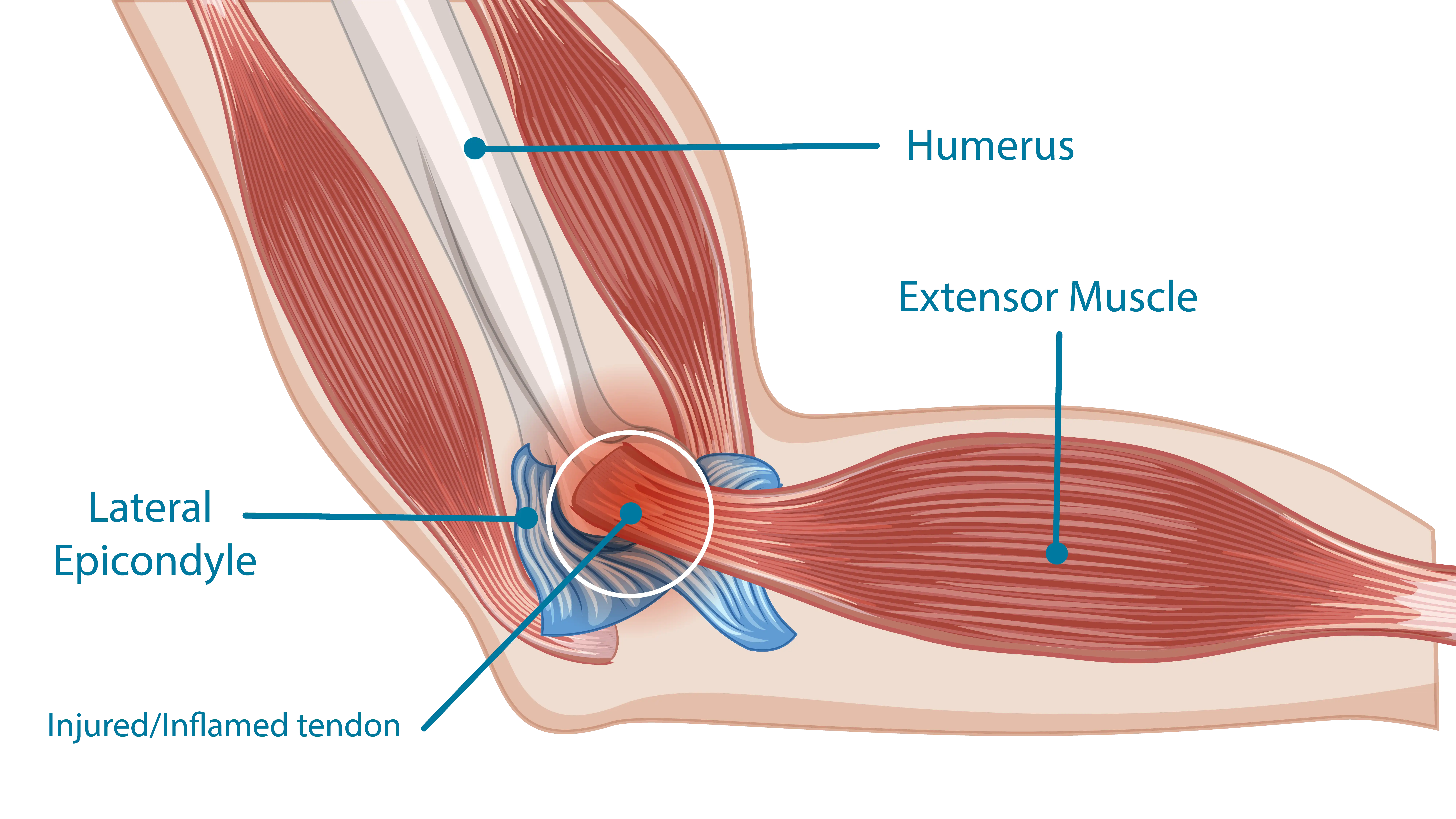 Anatomical Graphic of Tennis Elbow