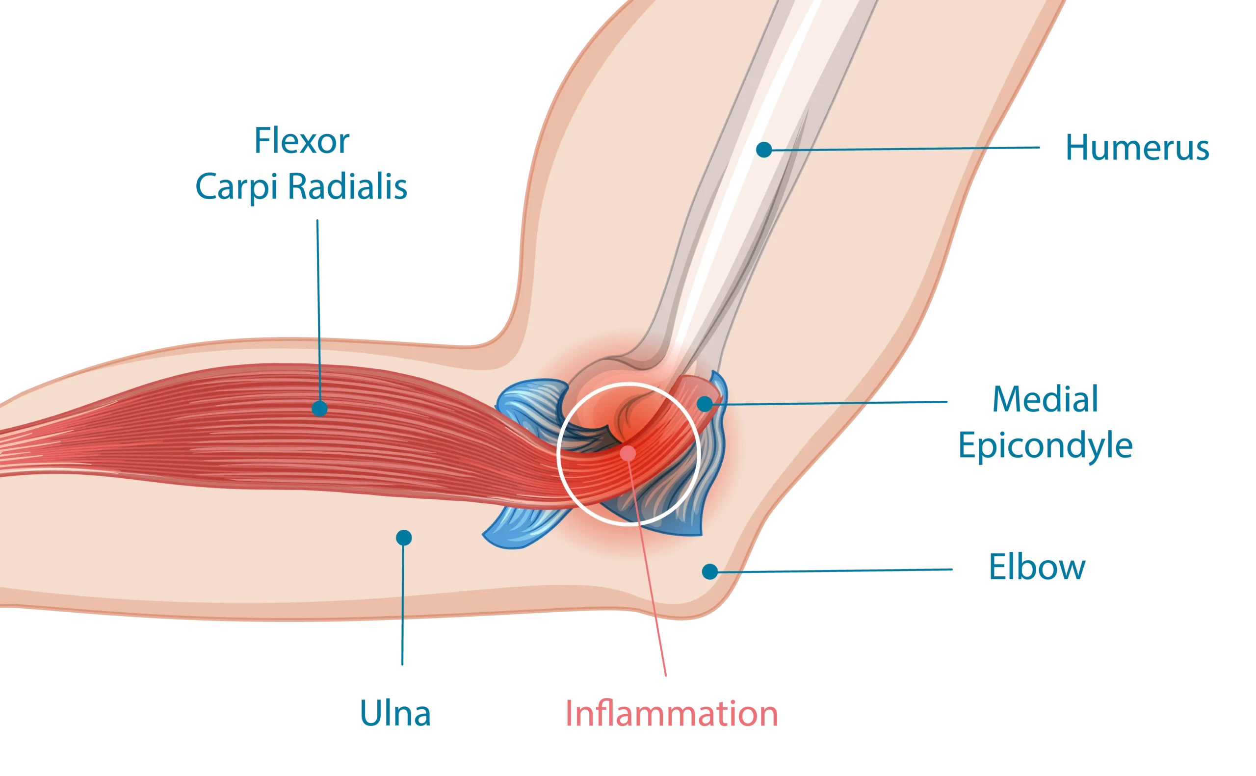 Anatomical Graphic of Golfer's Elbow