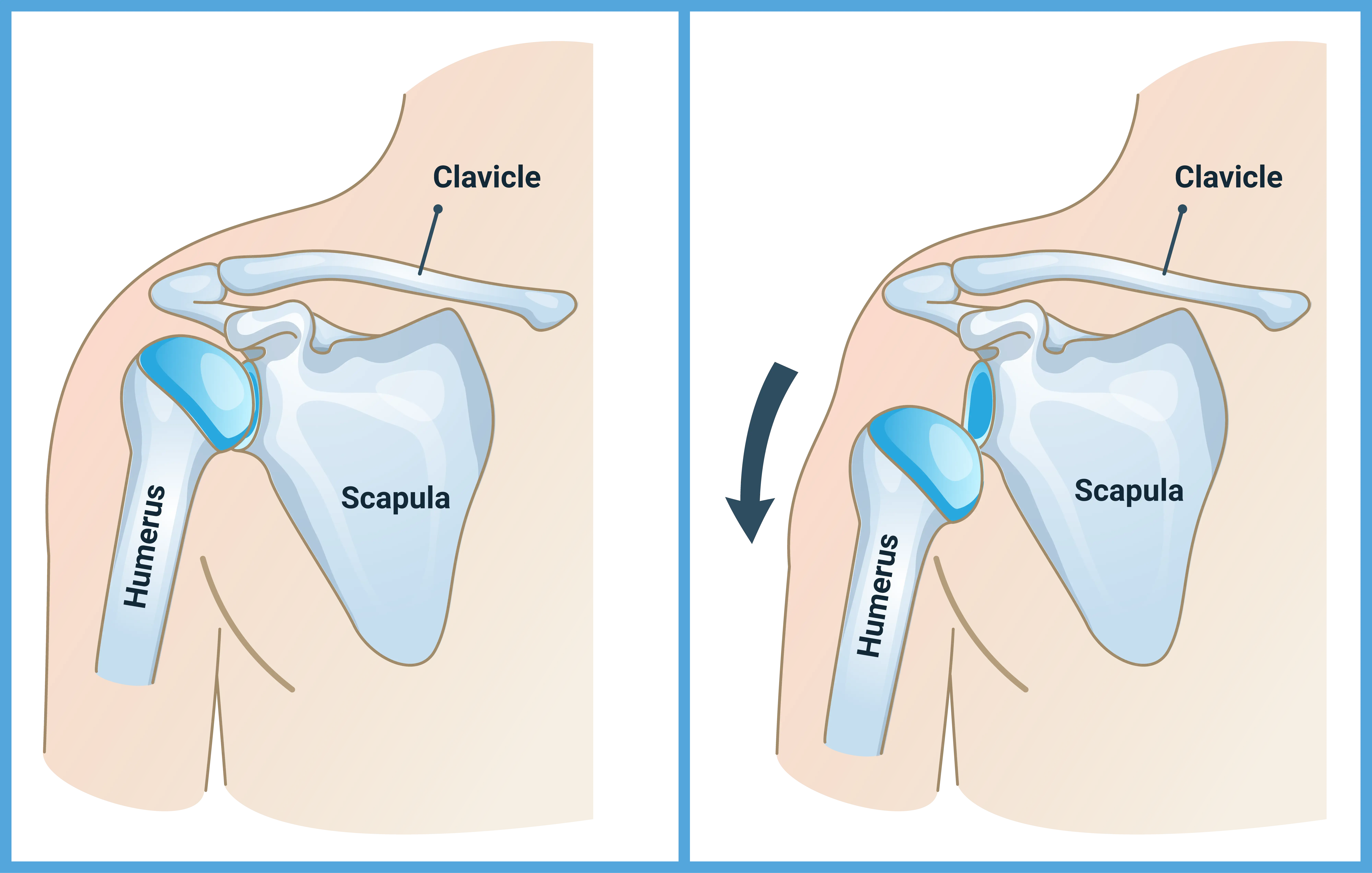 Anatomical Graphic of Shoulder Dislocation