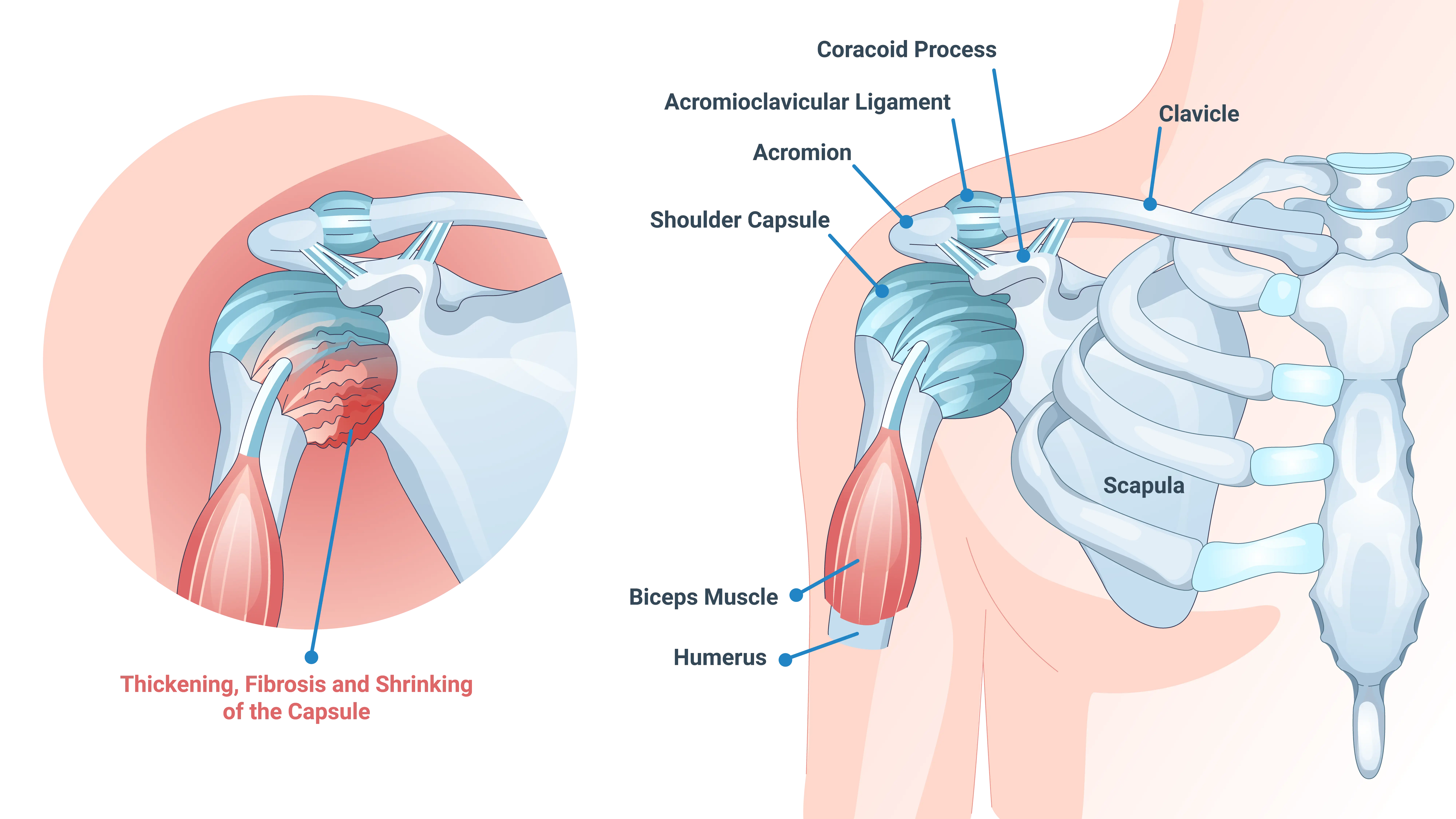 Anatomical Graphic of Frozen Shoulder