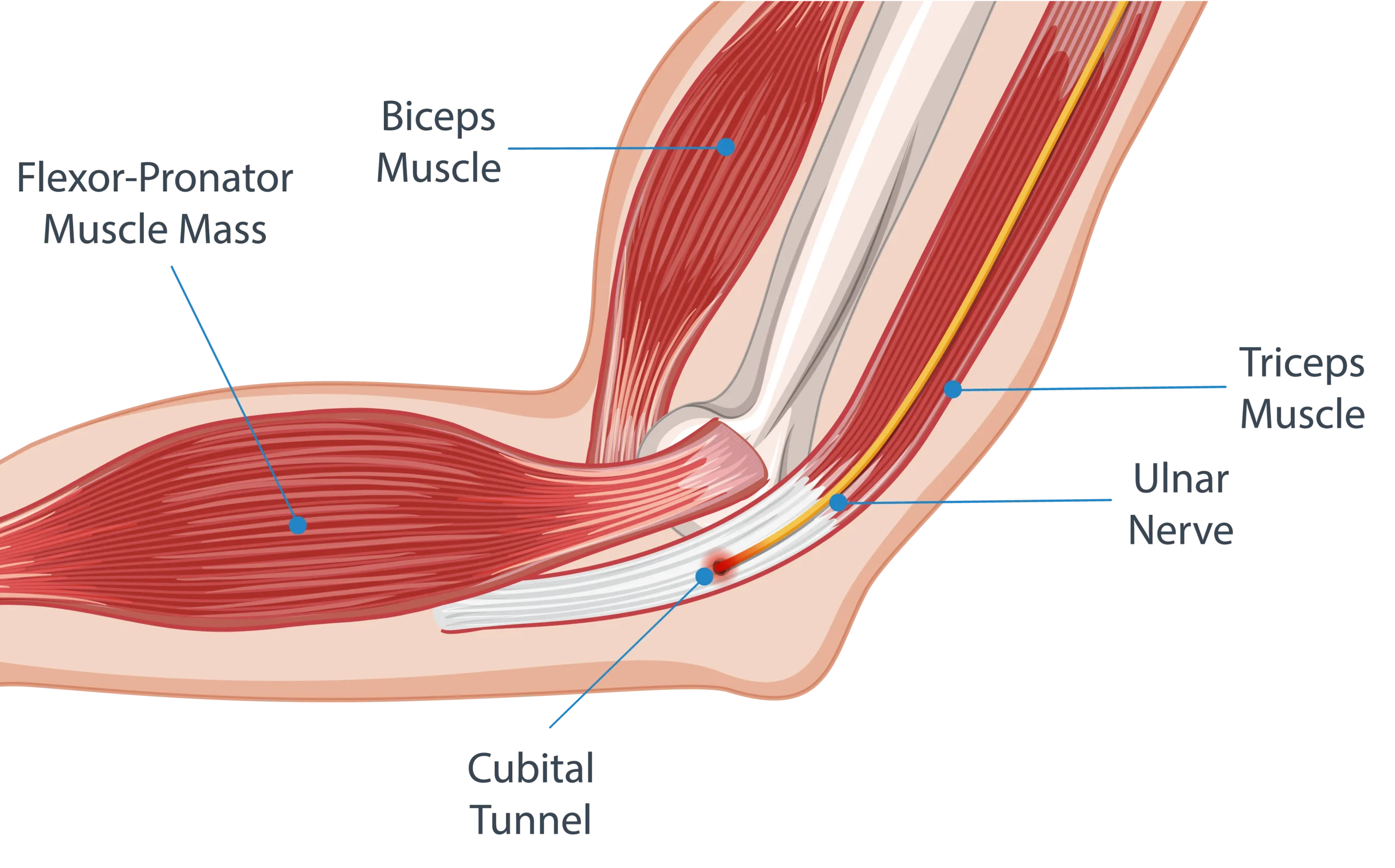 Cubital Tunnel Syndrome