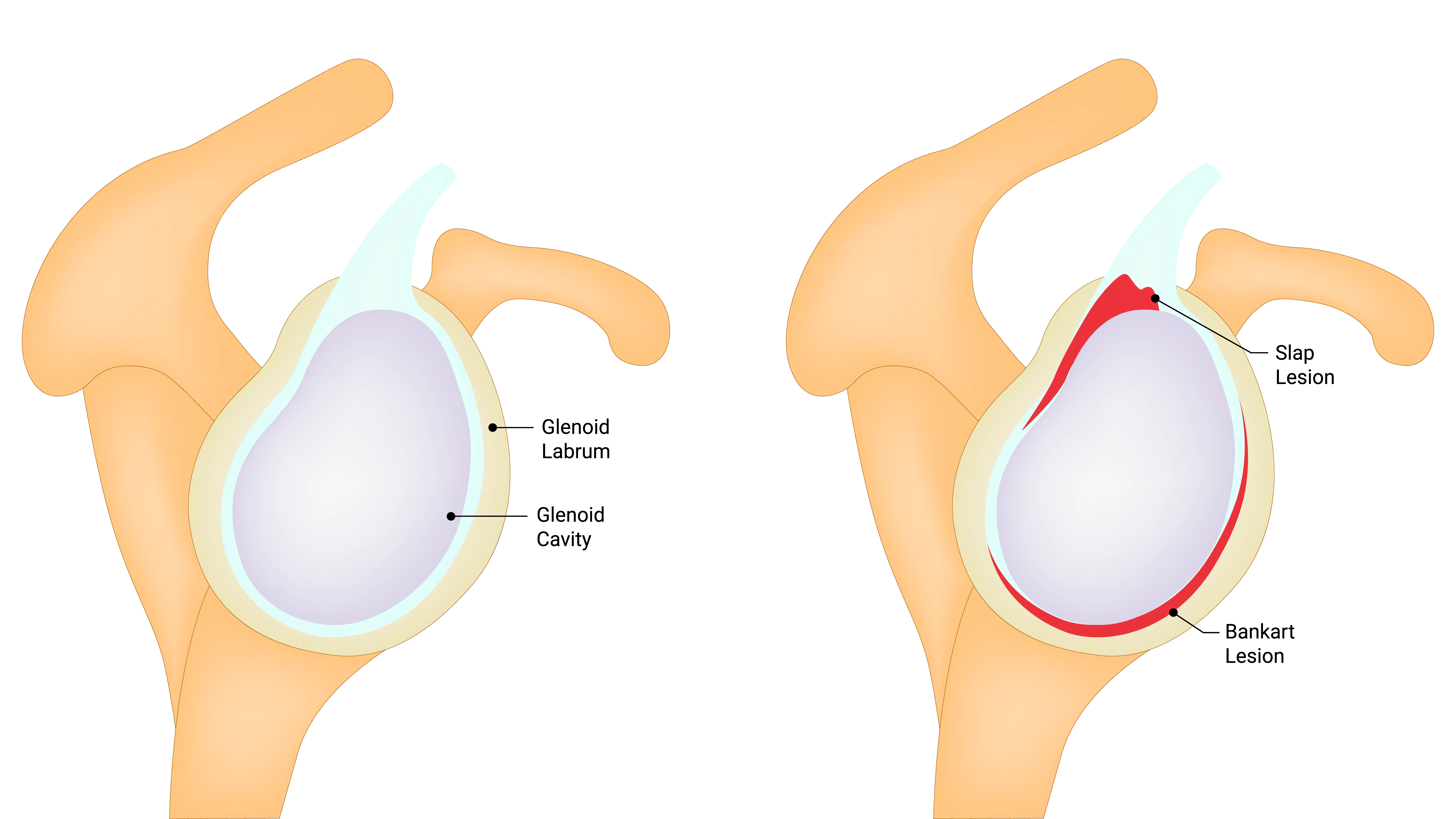 Anatomical graphic of labral tear