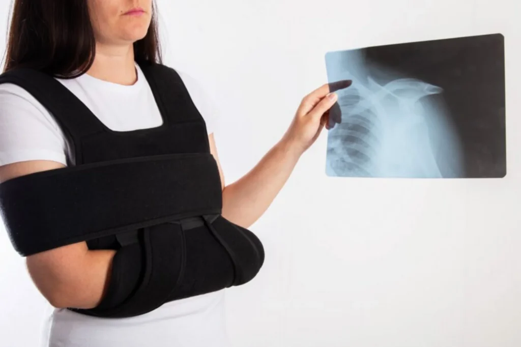Woman holding xray with broken arm
