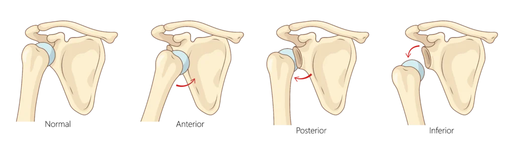 Different types of shoulder dislocations