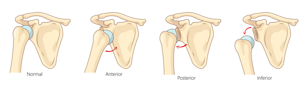 A diagram of different types of shoulder dislocations including anterior, posterior, and inferior dislocations.