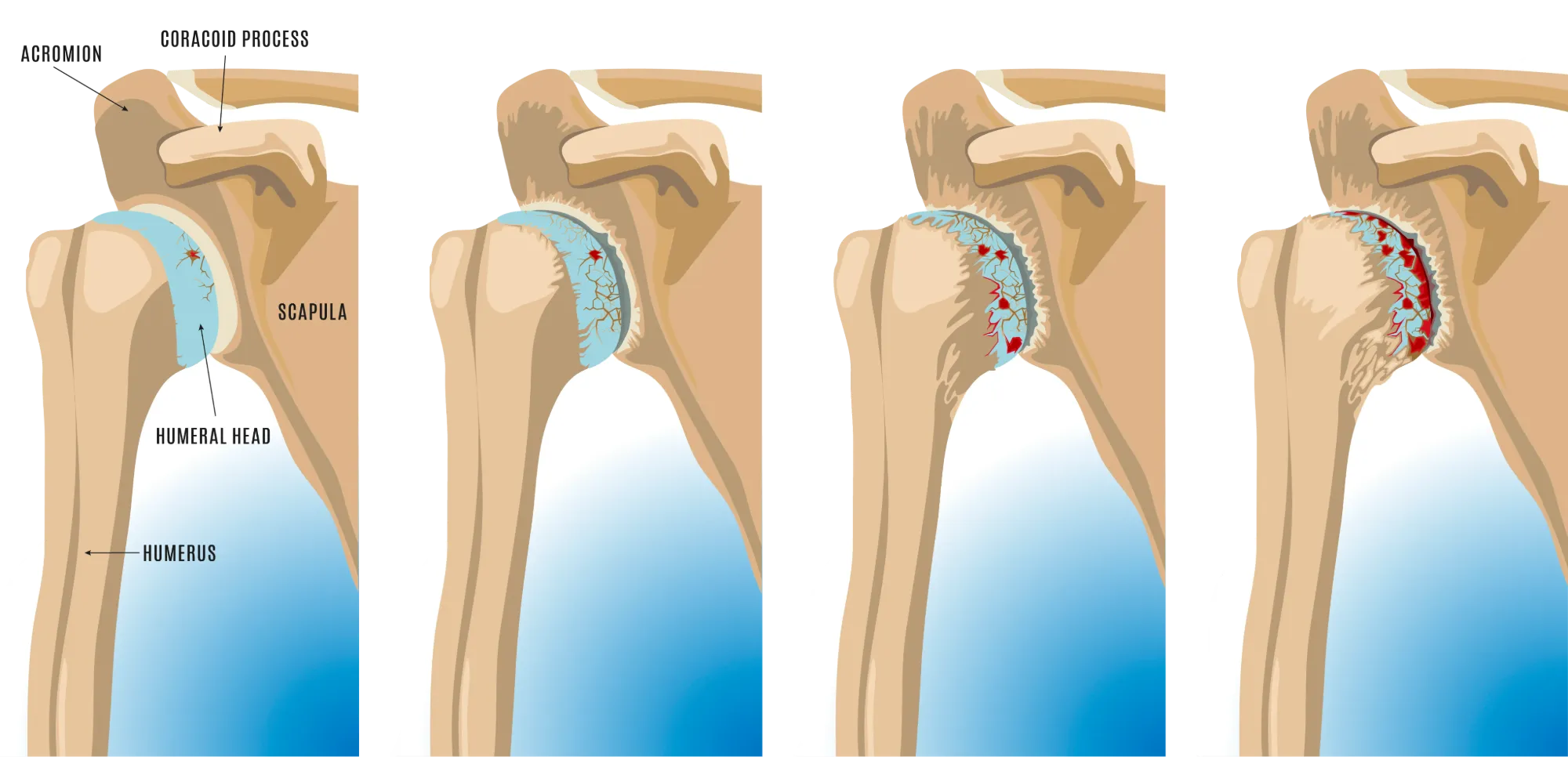 Shoulder Arthritis Anatomical Graphic
