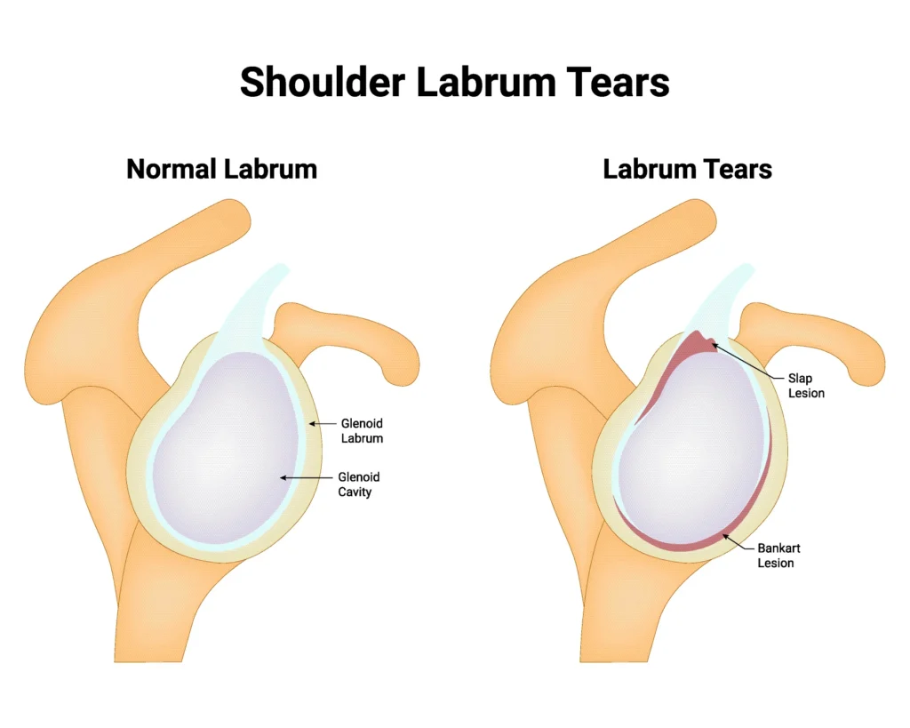 a normal and torn labrum illustration
