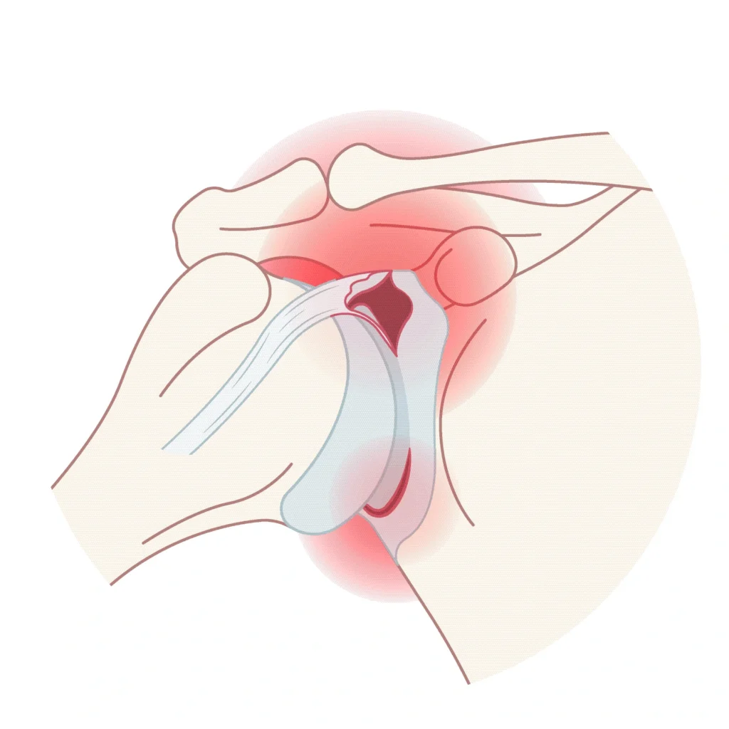 Image of a rotator cuff tear in the shoulder.