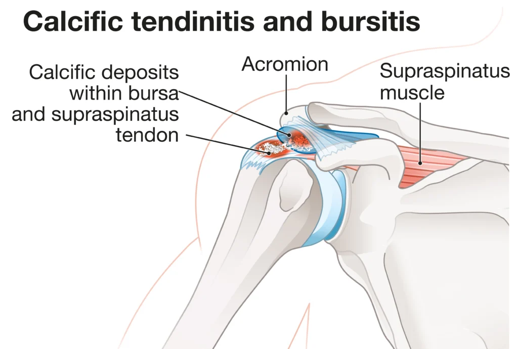 anatomical diagram of calcific tendonitis.