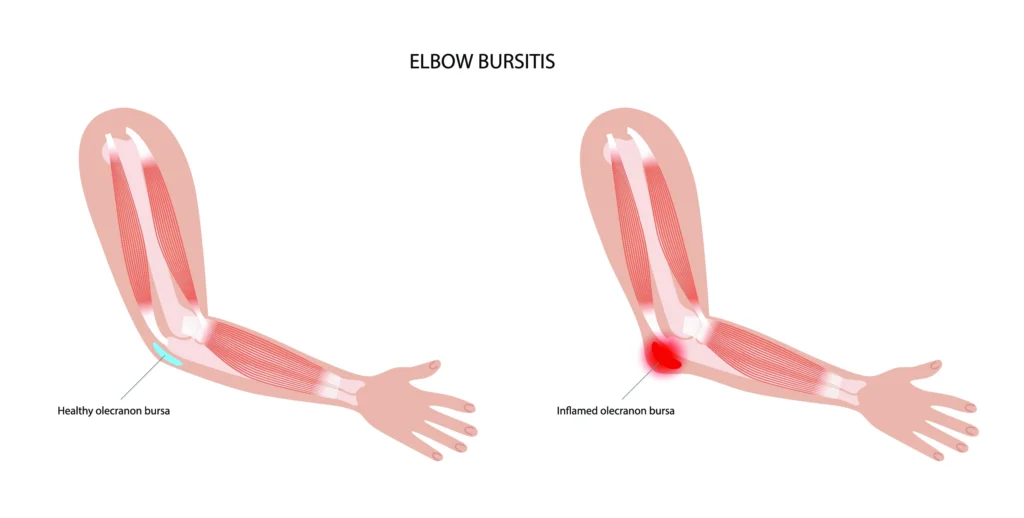 elbow bursitis diagram diagram of elbow bursitis, comparison between a healthy and irritated elbow.