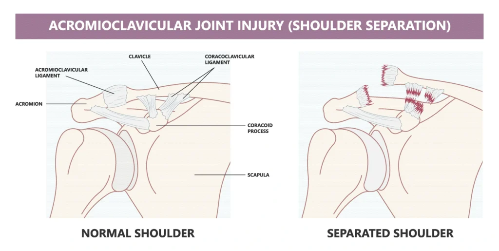 AC joint separation diagram, comparison between a healthy and separated shoulder