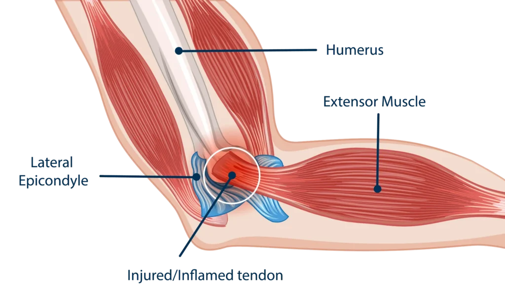 Elbow Arthritis Graphic Anatomical diagram of elbow arthritis