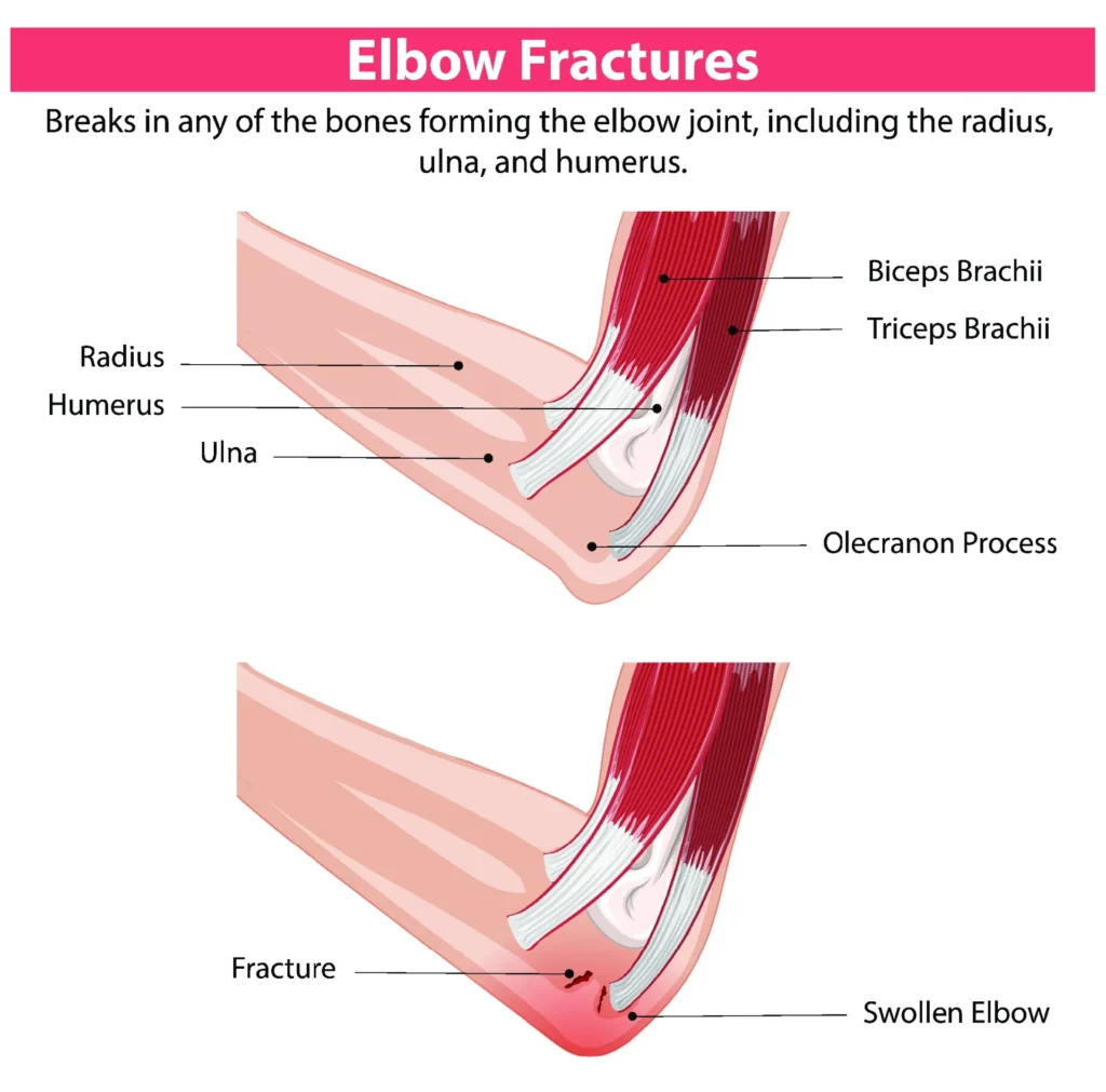 elbow fractures comparison Diagram of the elbow, comparing a healthy elbow to a fractured elbow