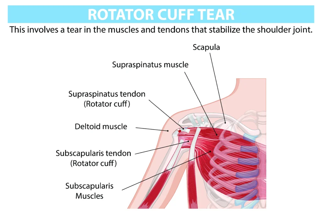 rotator_cuff_tear_diagram The difference between a Shoulder Labral tear and a Rotator Cuff tear