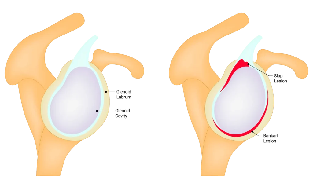 Shoulder stabilization structure.