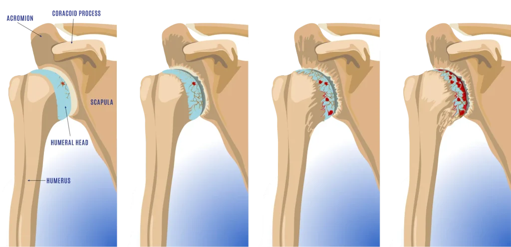 Diagram of shoulder arthritis 